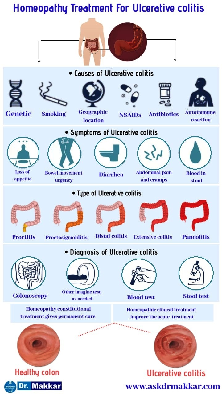 Ulcerative colitis Online Homeopathy Treatment with Best Homeopathy